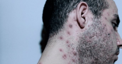 La viruela del mono tiene una mortalidad del 6 por ciento de la poblaci&oacute;n, asegur&oacute; infectologa