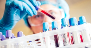 "Un estudio hist&oacute;rico  de sangre&rdquo; detecta 50 tipos de tumores antes de los s&iacute;ntomas